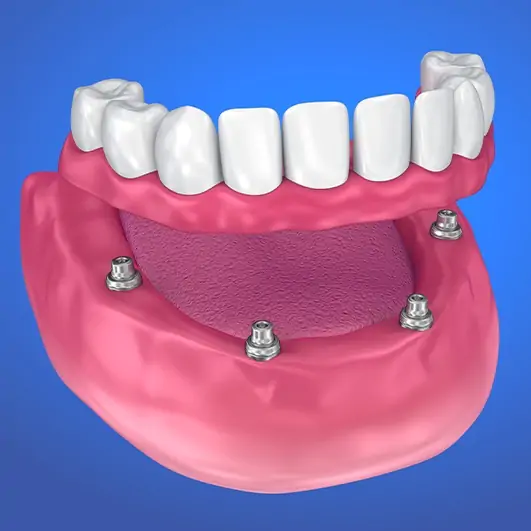 Dental implants in Chalfont St Giles