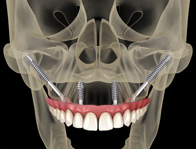 Dental implants in Buckinghamshire