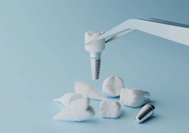 Dental Implantology Glossary