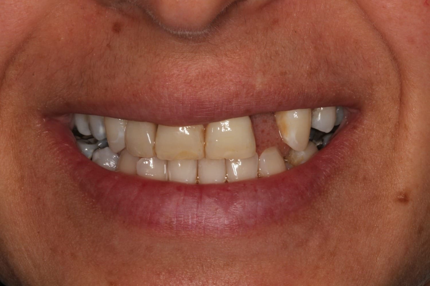 Before
