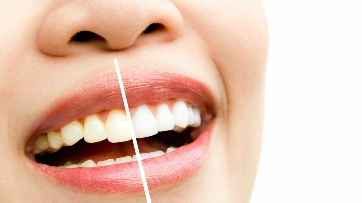 Can teeth whitening cause stains