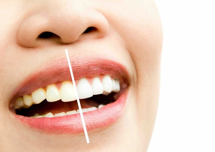 Can teeth whitening cause stains