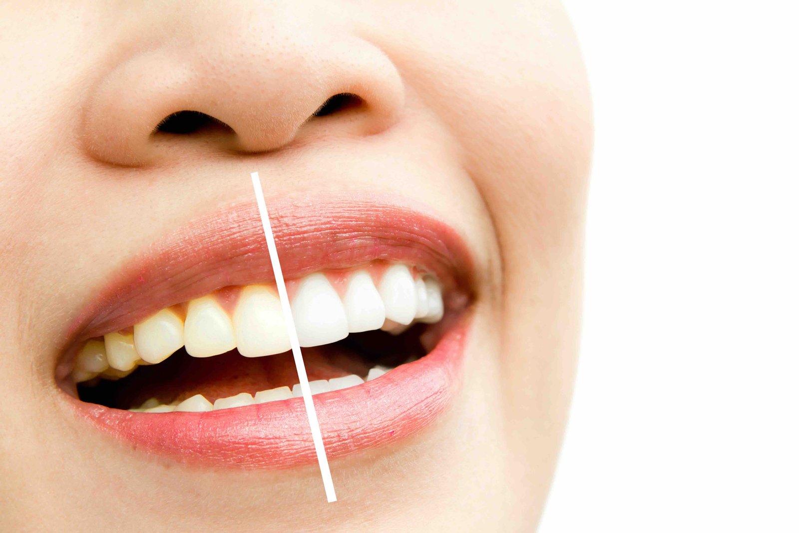 Can teeth whitening cause stains