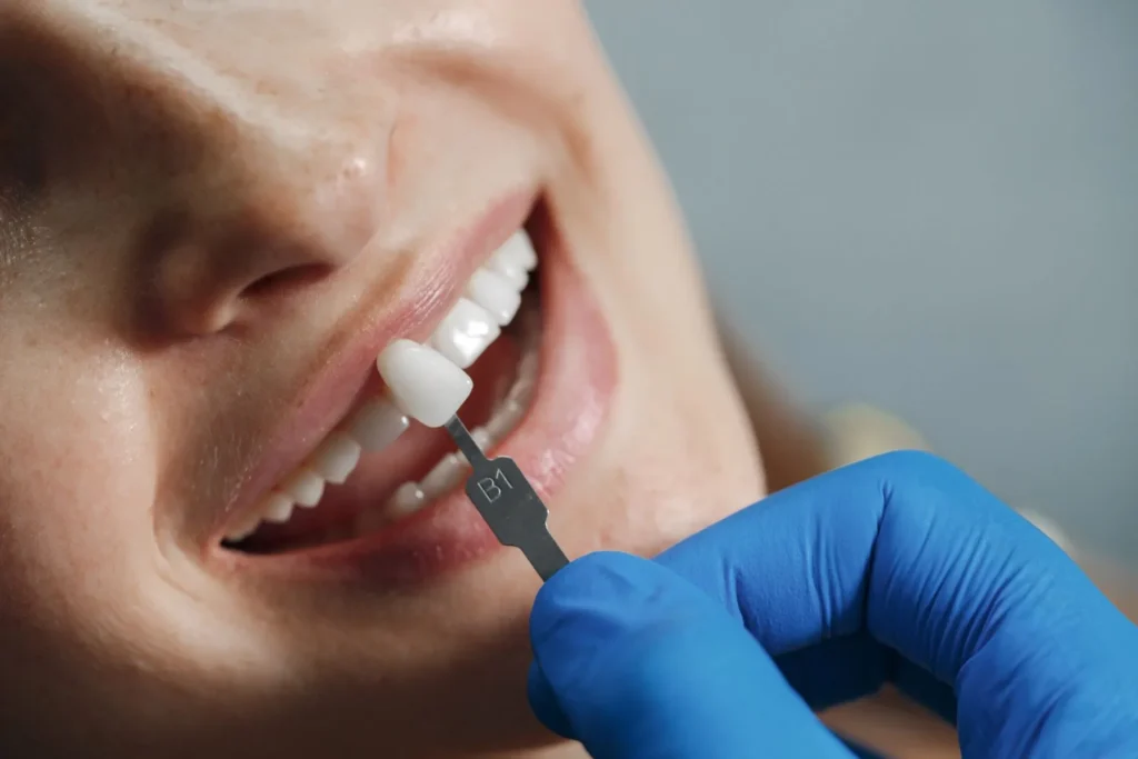 how long does composite bonding last