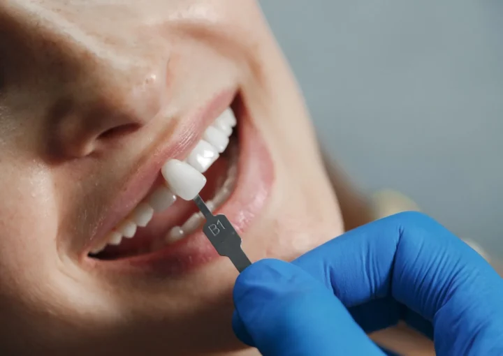 how long does composite bonding last