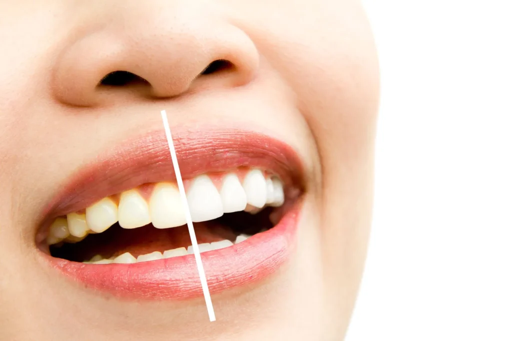 how long does teeth whitening last