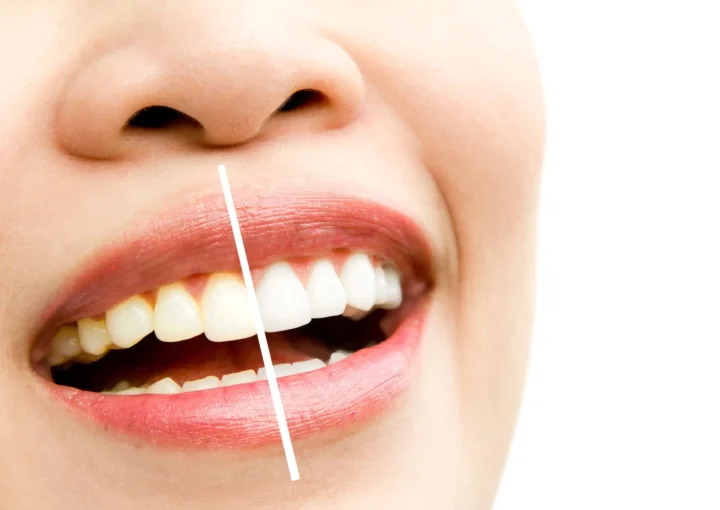 how long does teeth whitening last